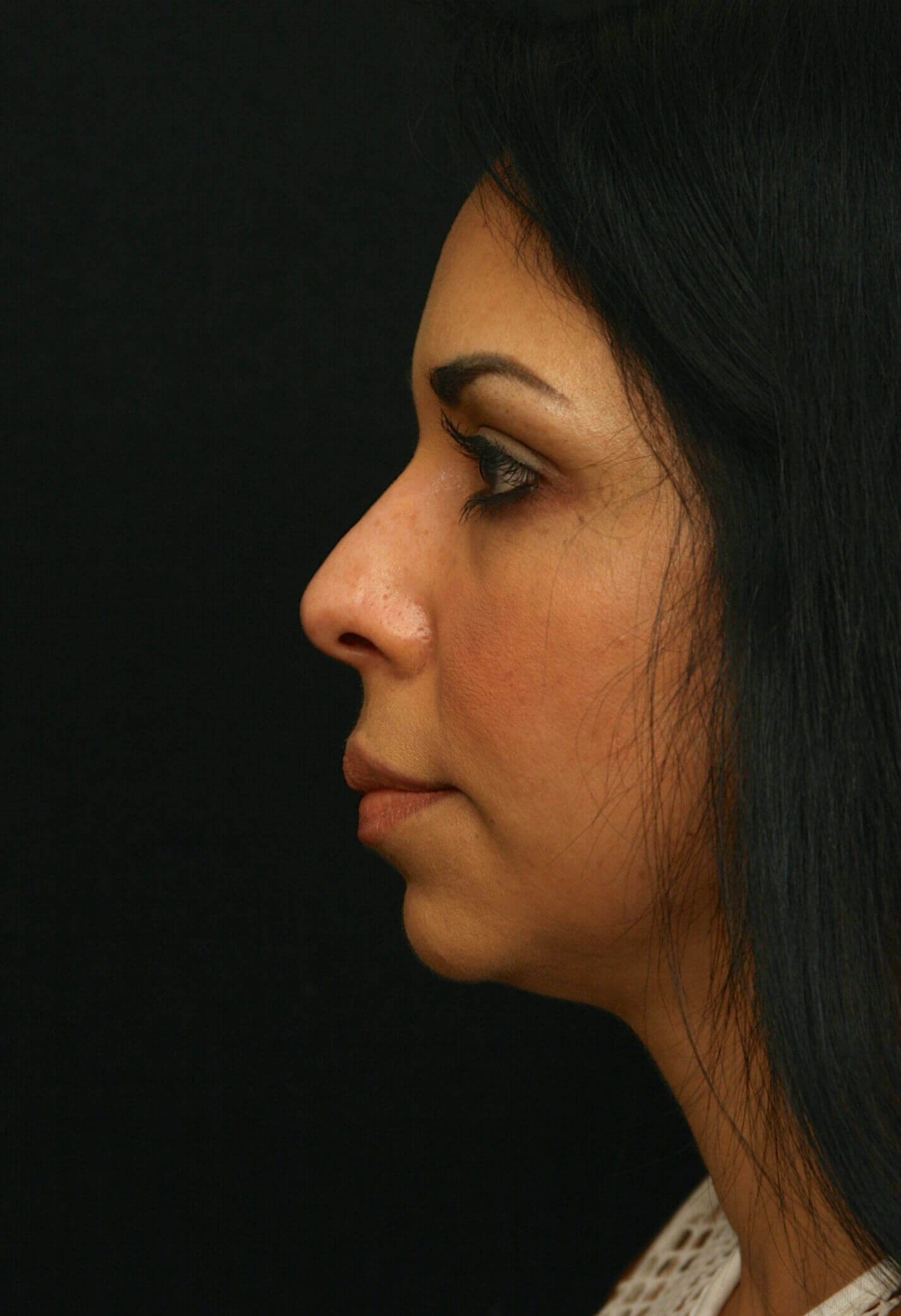 Rhinoplasty Before and After Before
