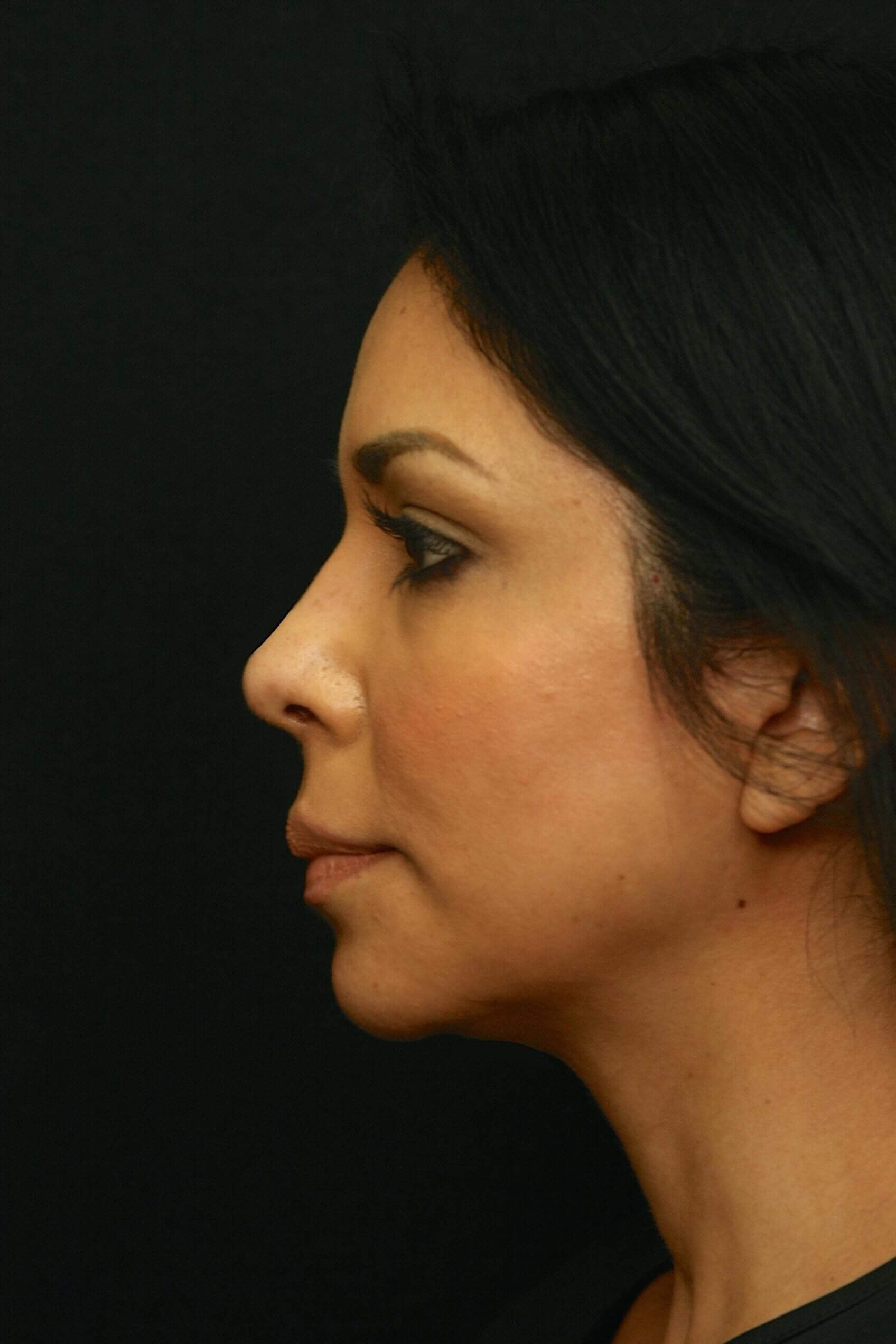 Rhinoplasty Before and After After