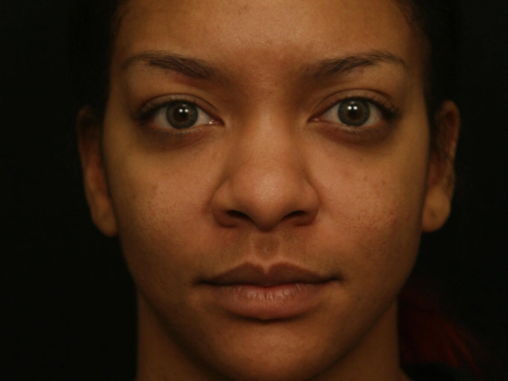 Rhinoplasty Before and After Before