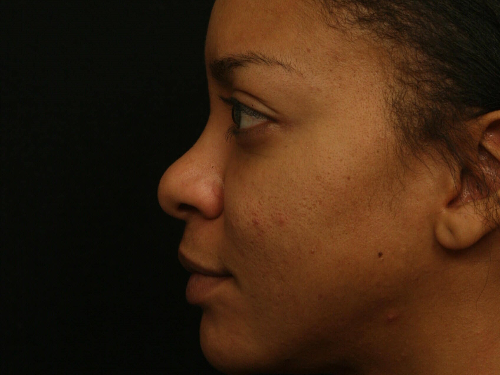 Rhinoplasty Before and After Before