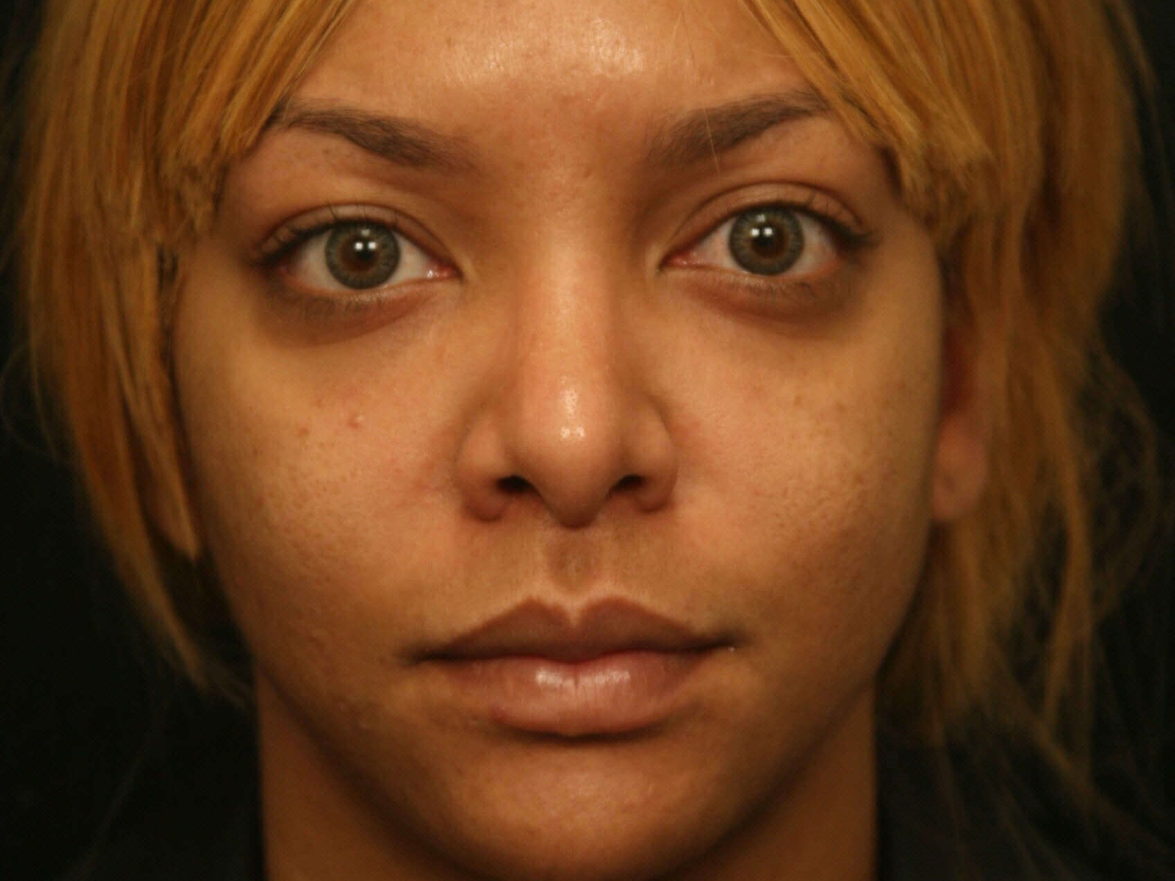 Rhinoplasty Before and After After