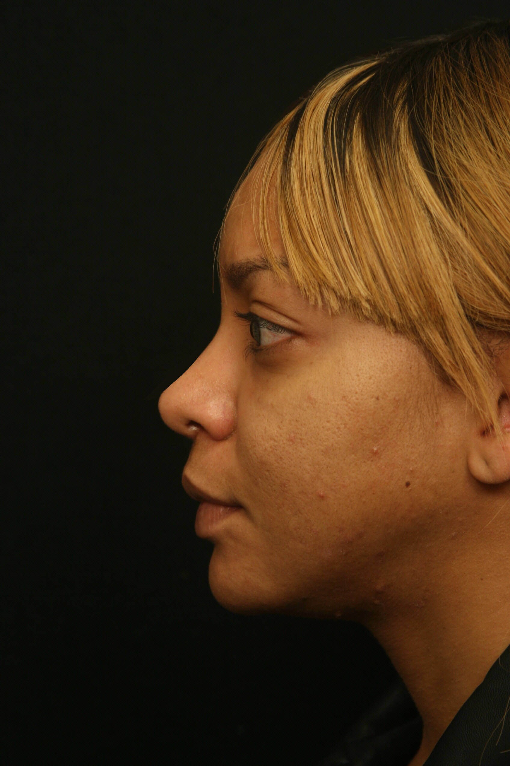 Rhinoplasty Before and After After