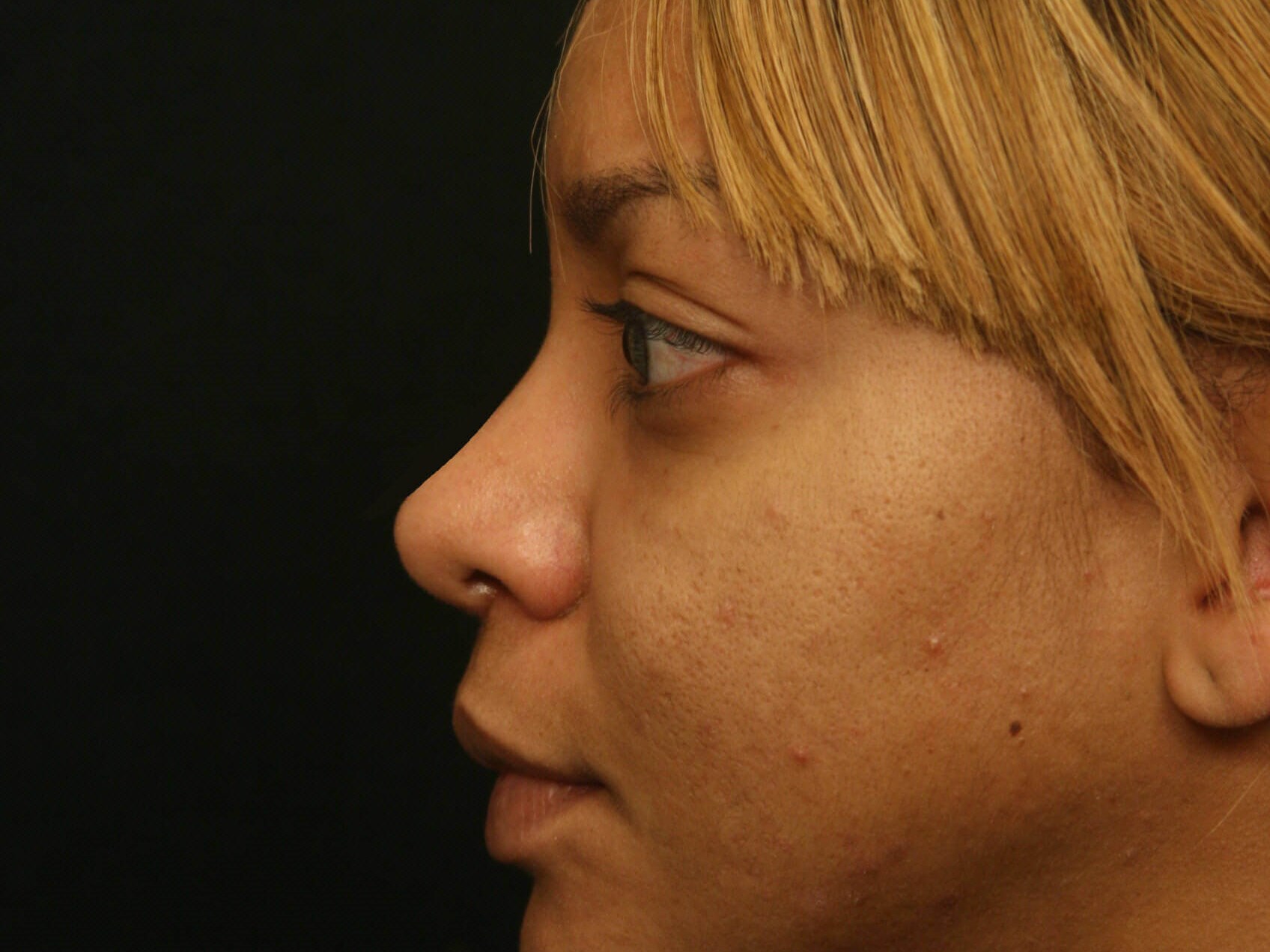 Rhinoplasty Before and After After