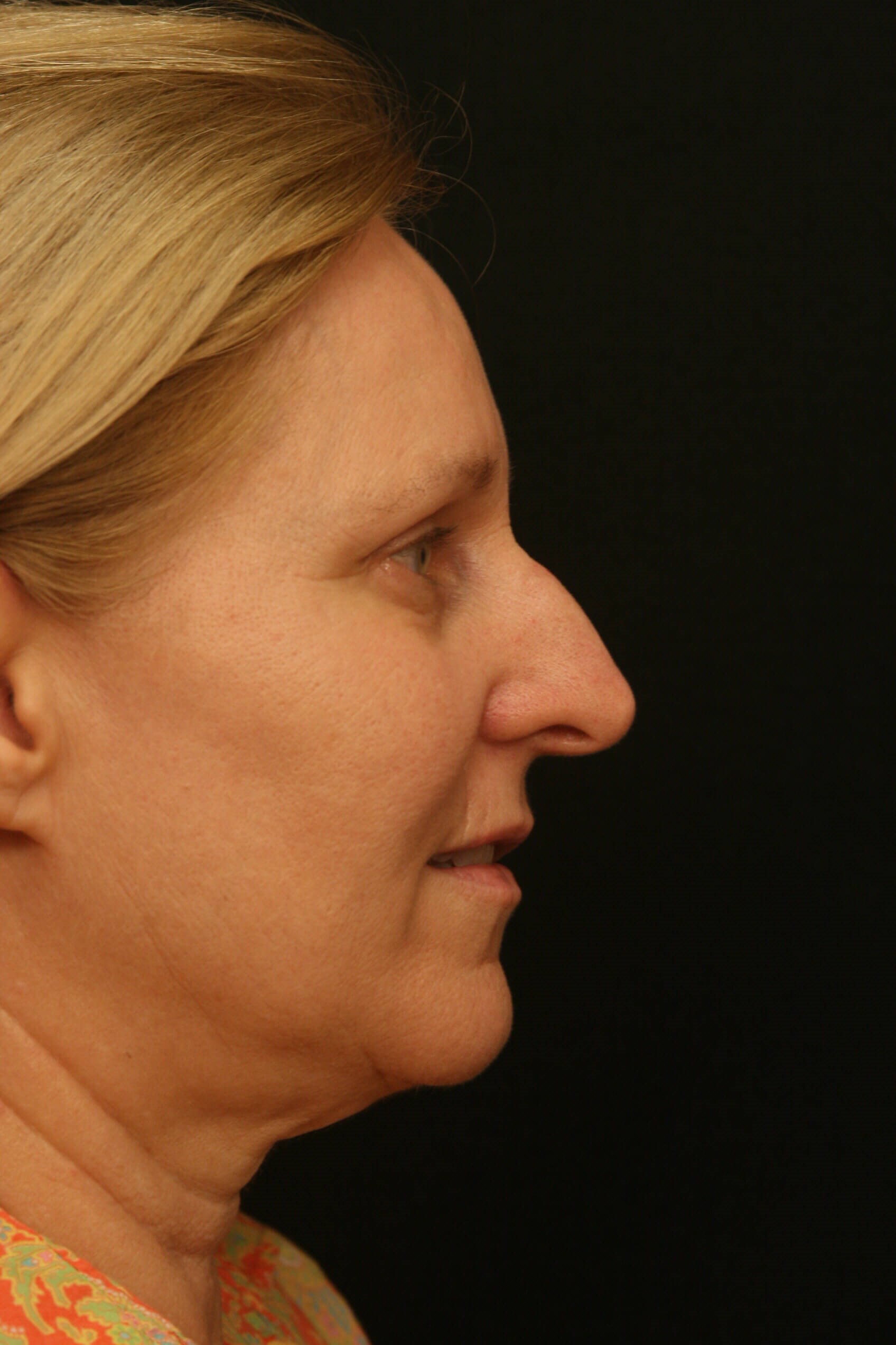 Rhinoplasty Before and After Before