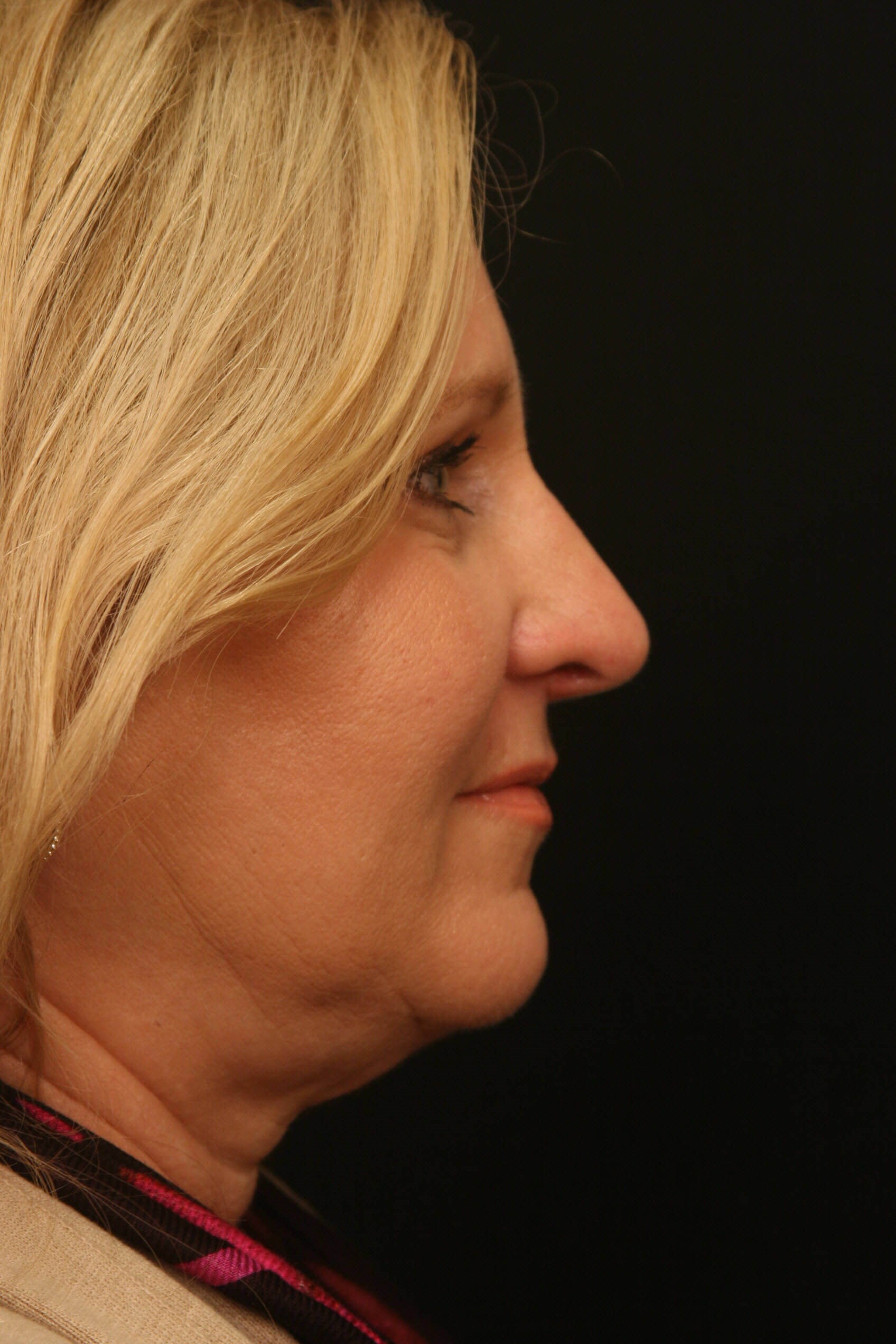 Rhinoplasty Before and After After