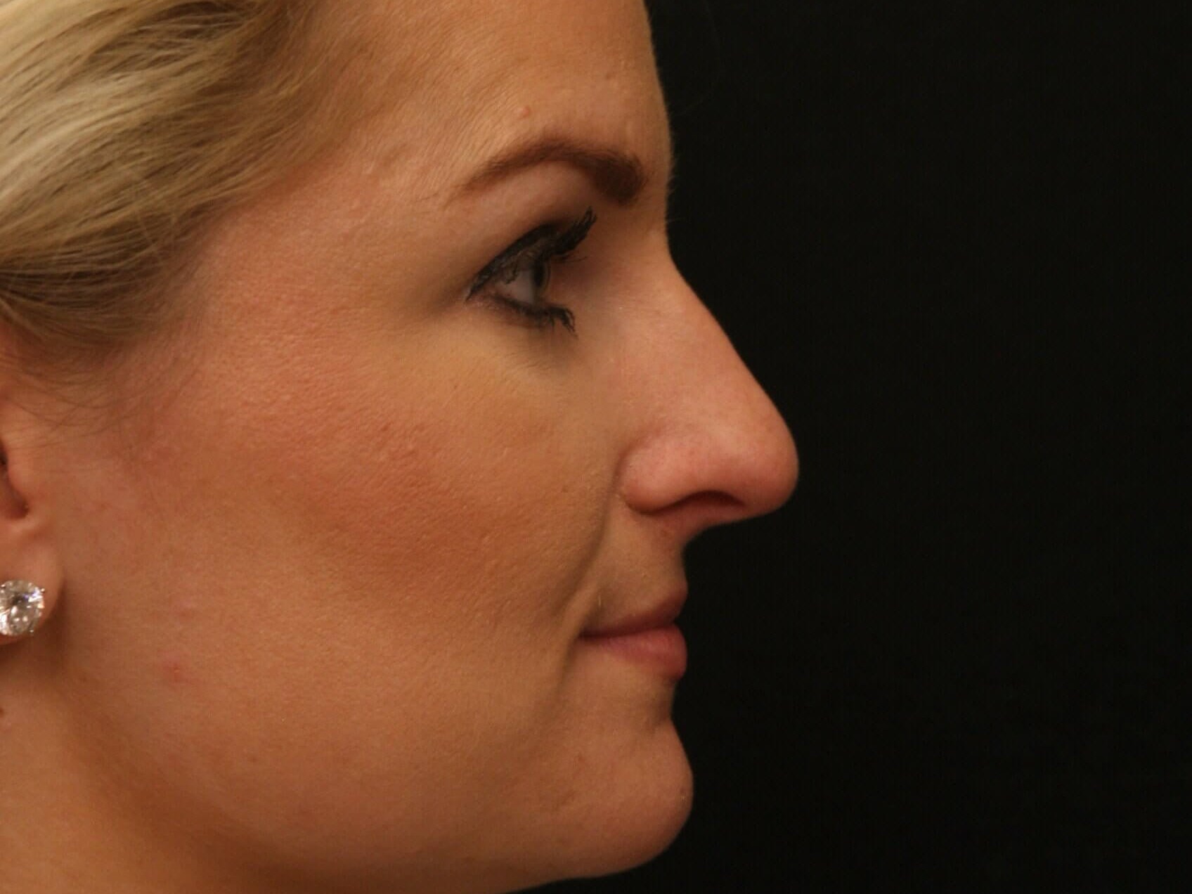 Rhinoplasty Before and After Before