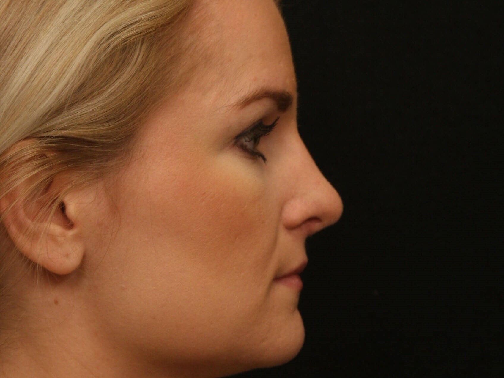 Rhinoplasty Before and After After