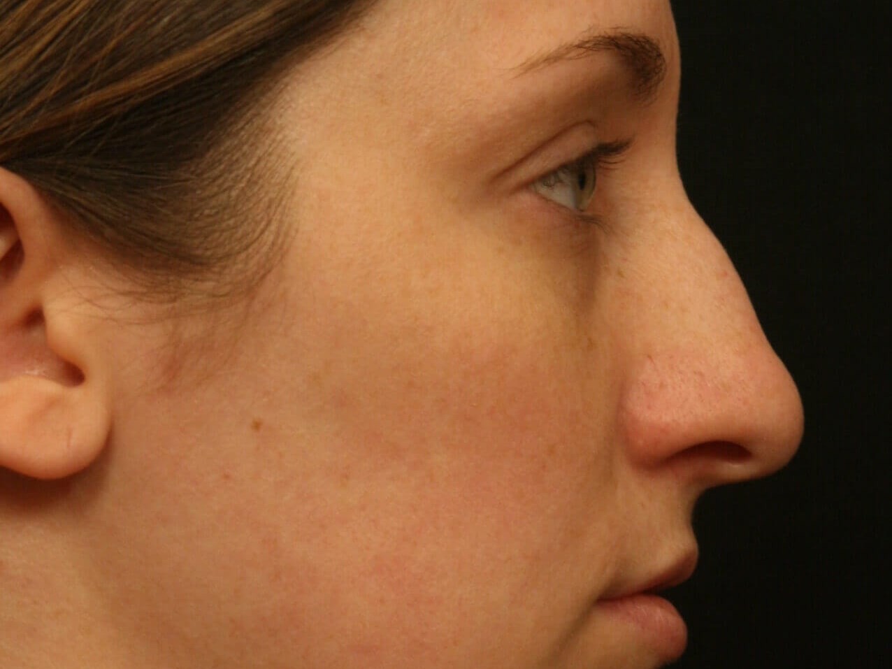 Rhinoplasty Before and After Before