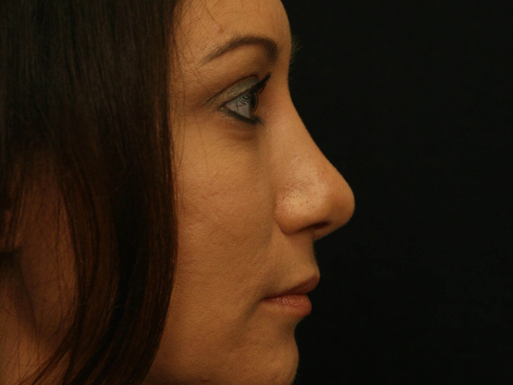 Rhinoplasty Before and After After