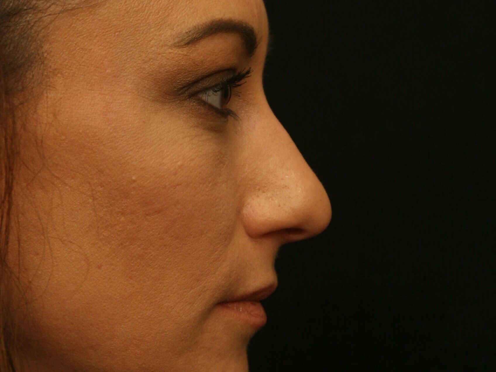 Rhinoplasty Before and After Before