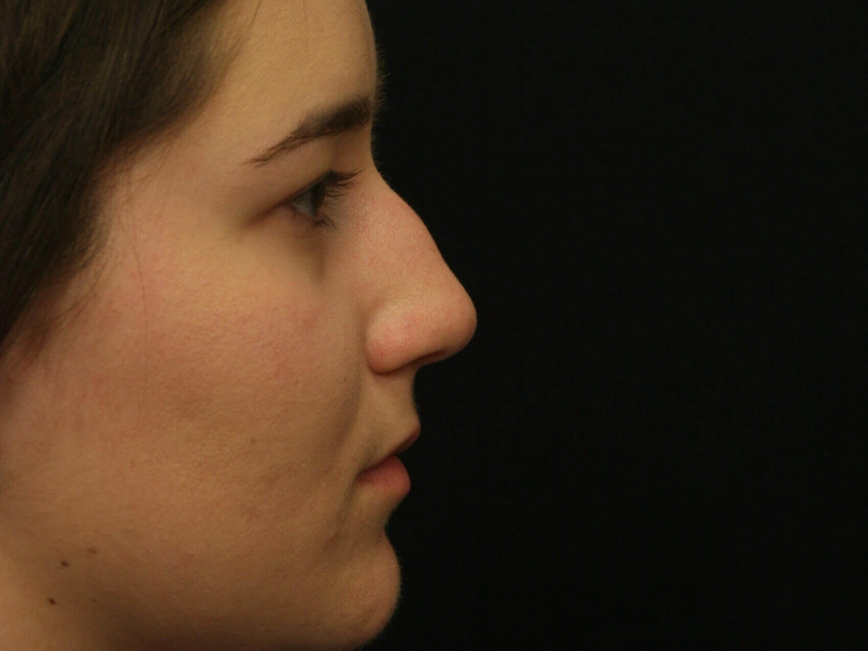 Rhinoplasty Before and After Before