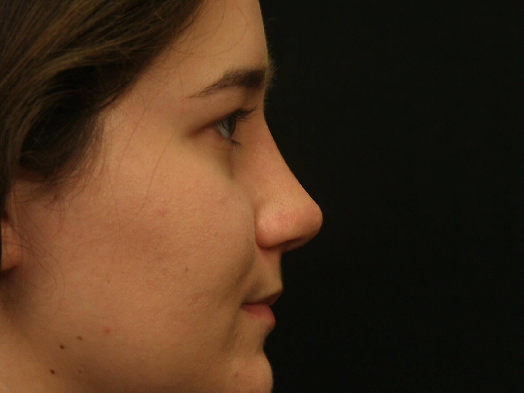 Rhinoplasty Before and After After