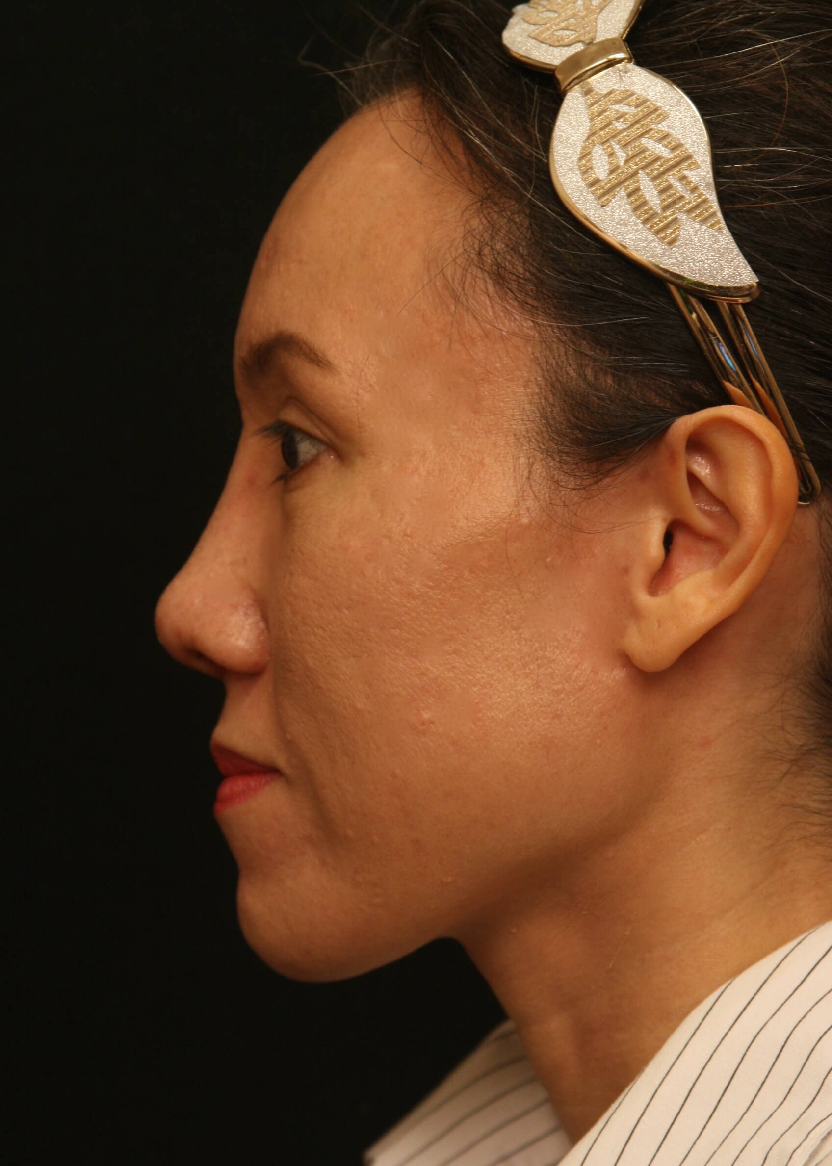 Rhinoplasty Before and After After