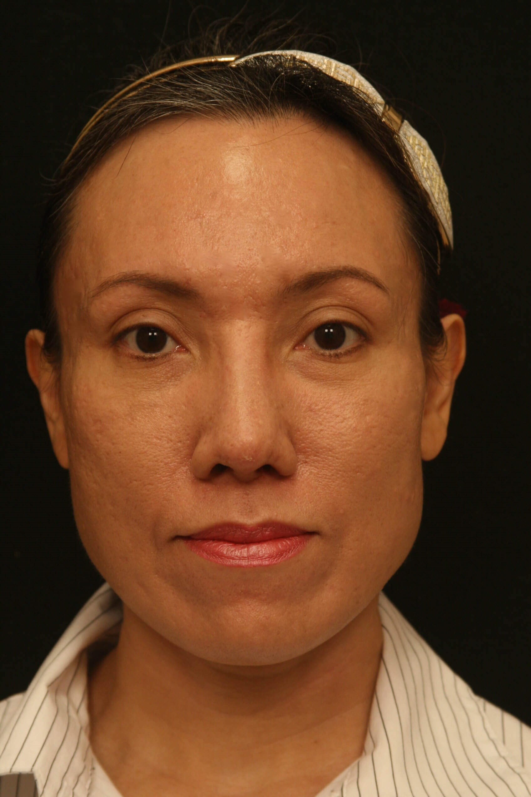 Rhinoplasty Before and After After