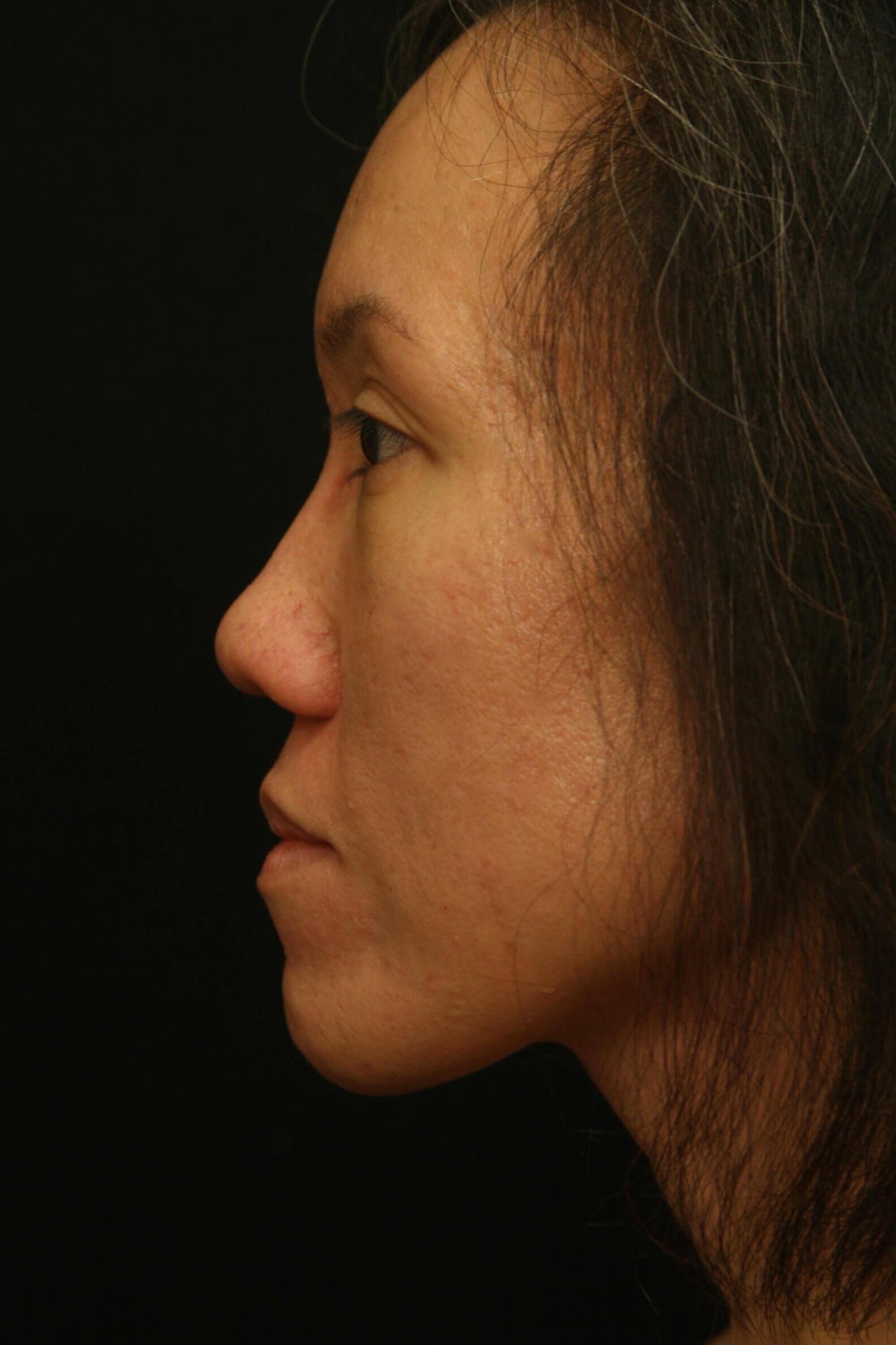 Rhinoplasty Before and After Before