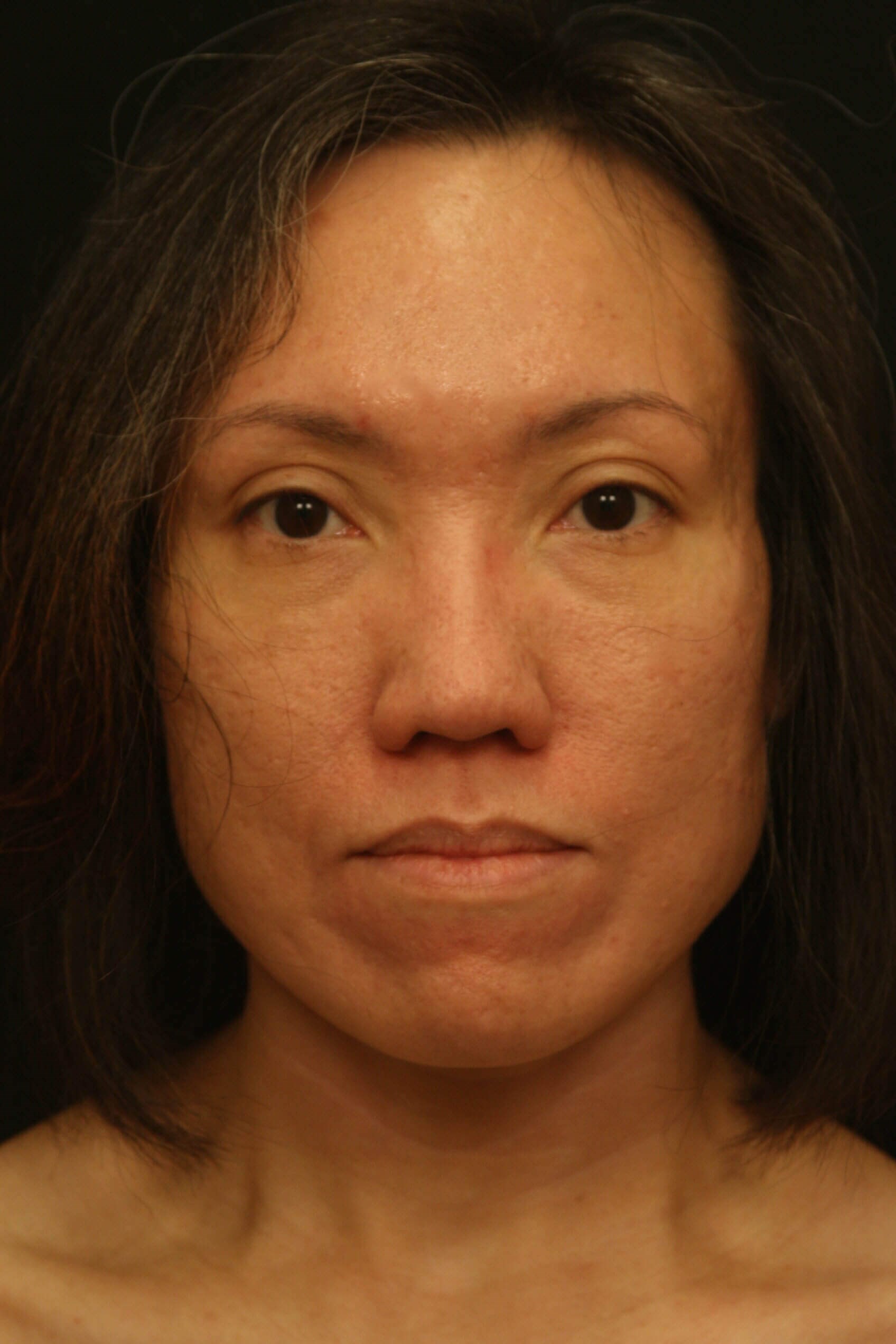 Rhinoplasty Before and After Before