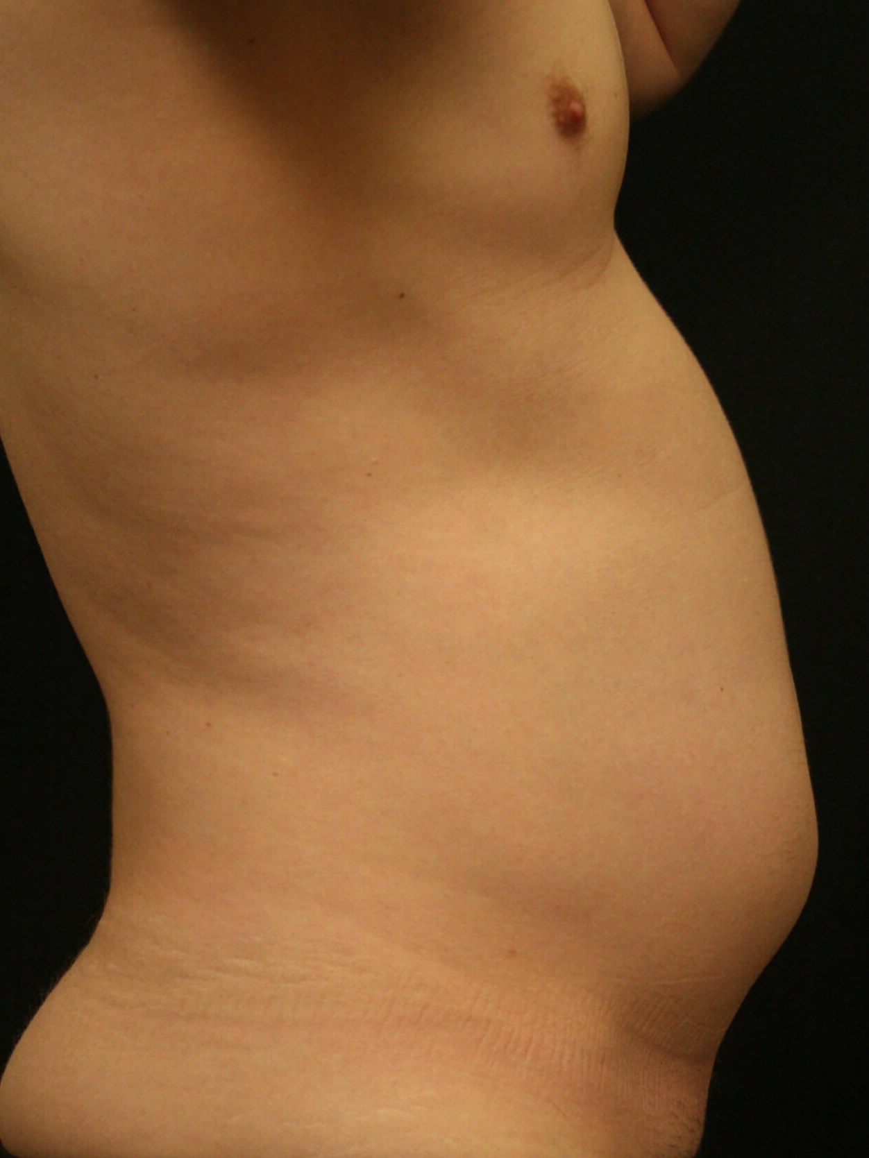 Liposuction Before and After Before