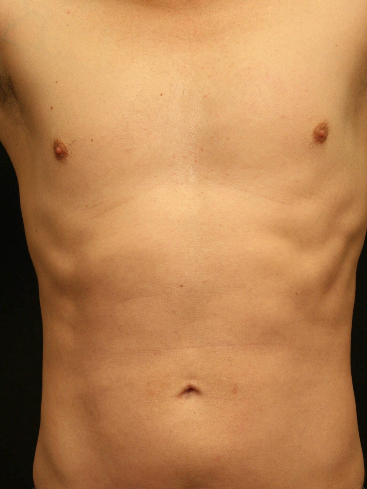 Liposuction Before and After After