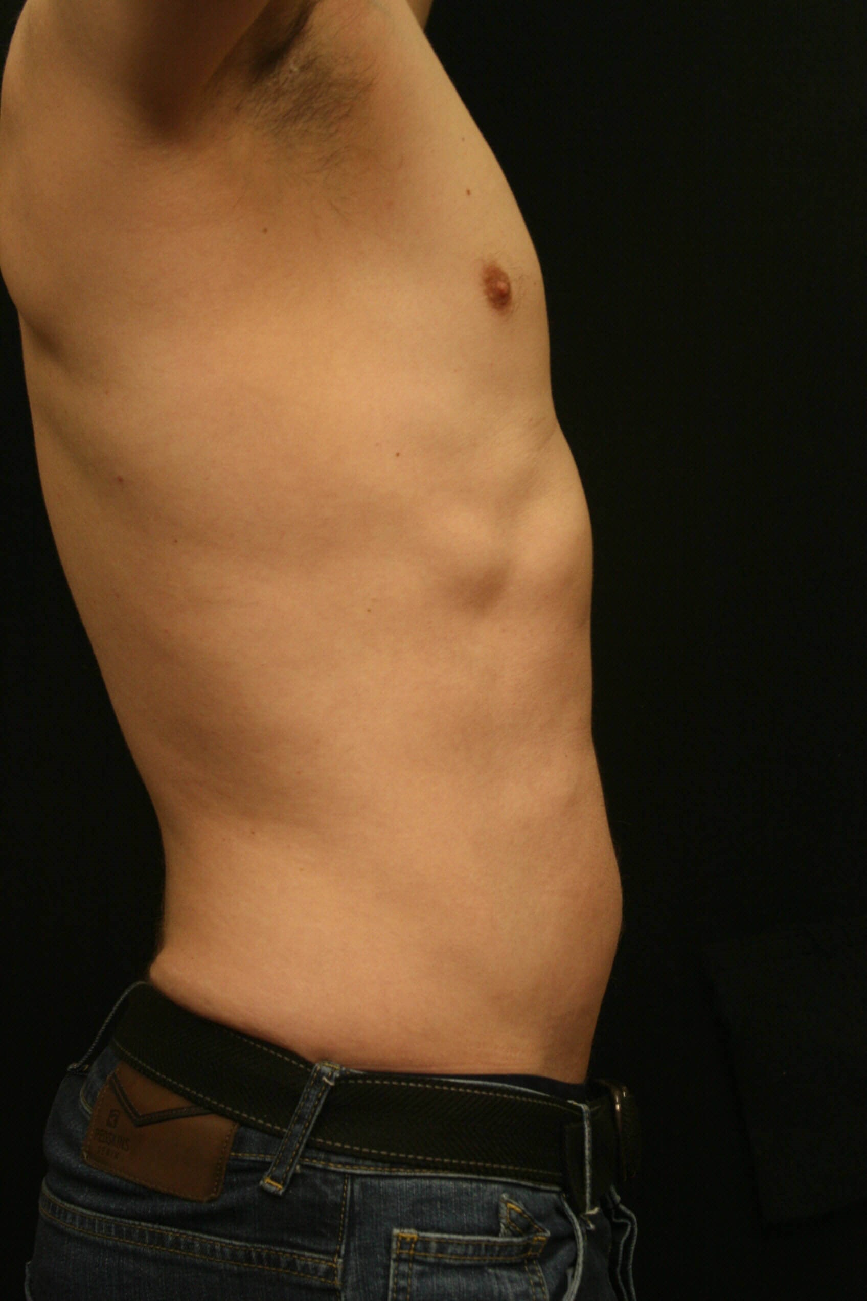 Liposuction Before and After After
