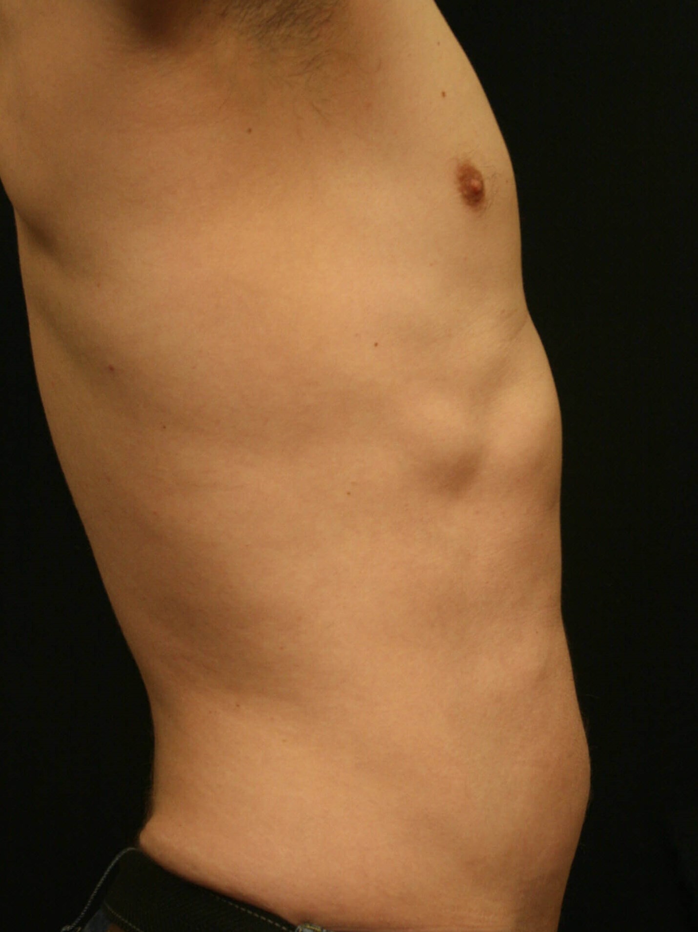 Liposuction Before and After After