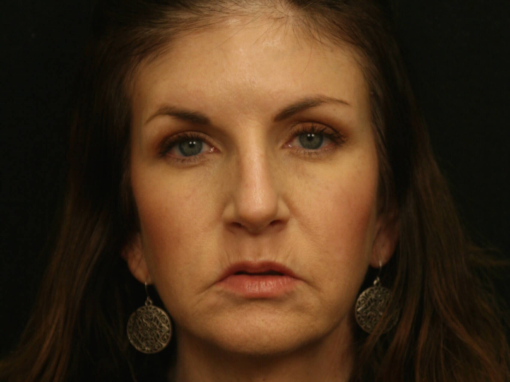 Forehead Lift Before and After After