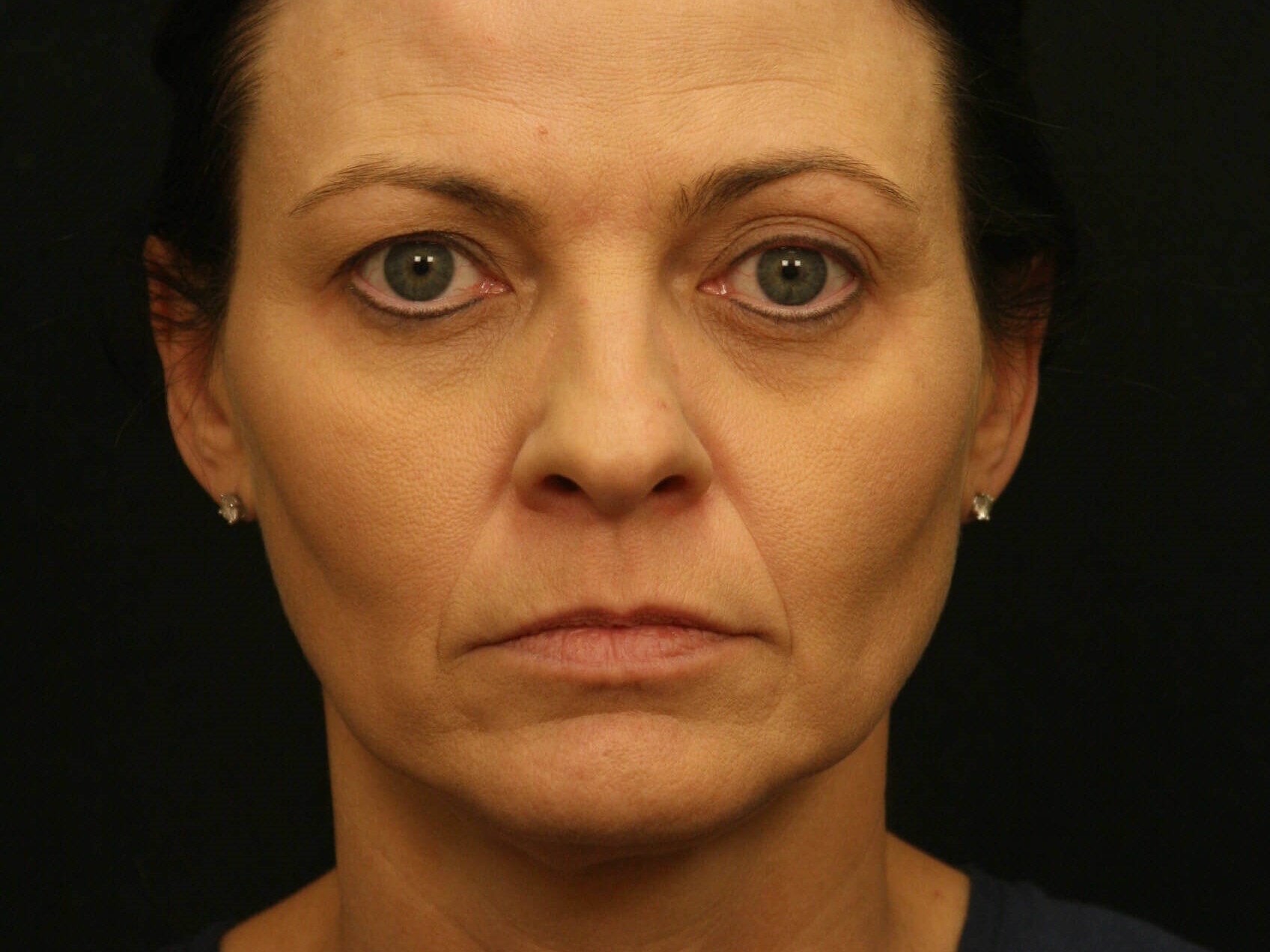 Forehead Lift Before and After Before