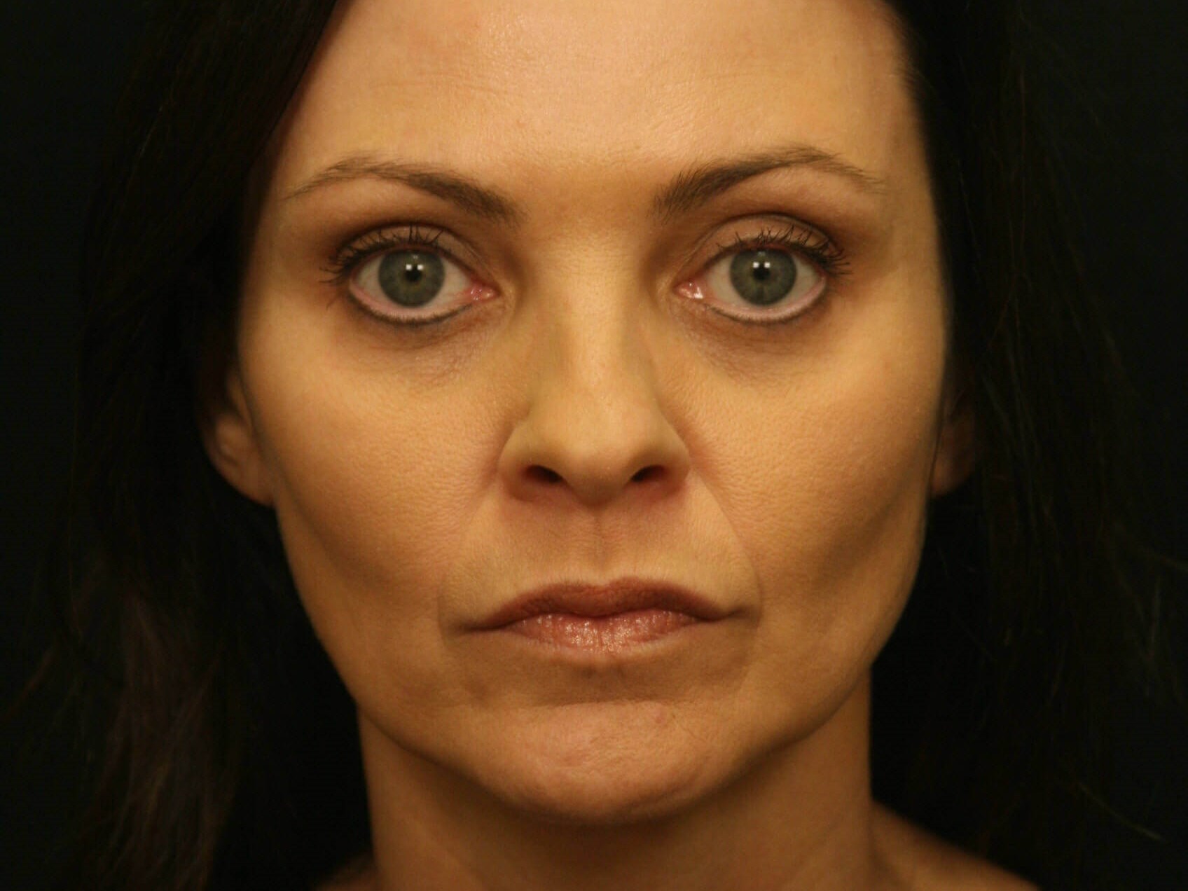 Forehead Lift Before and After After