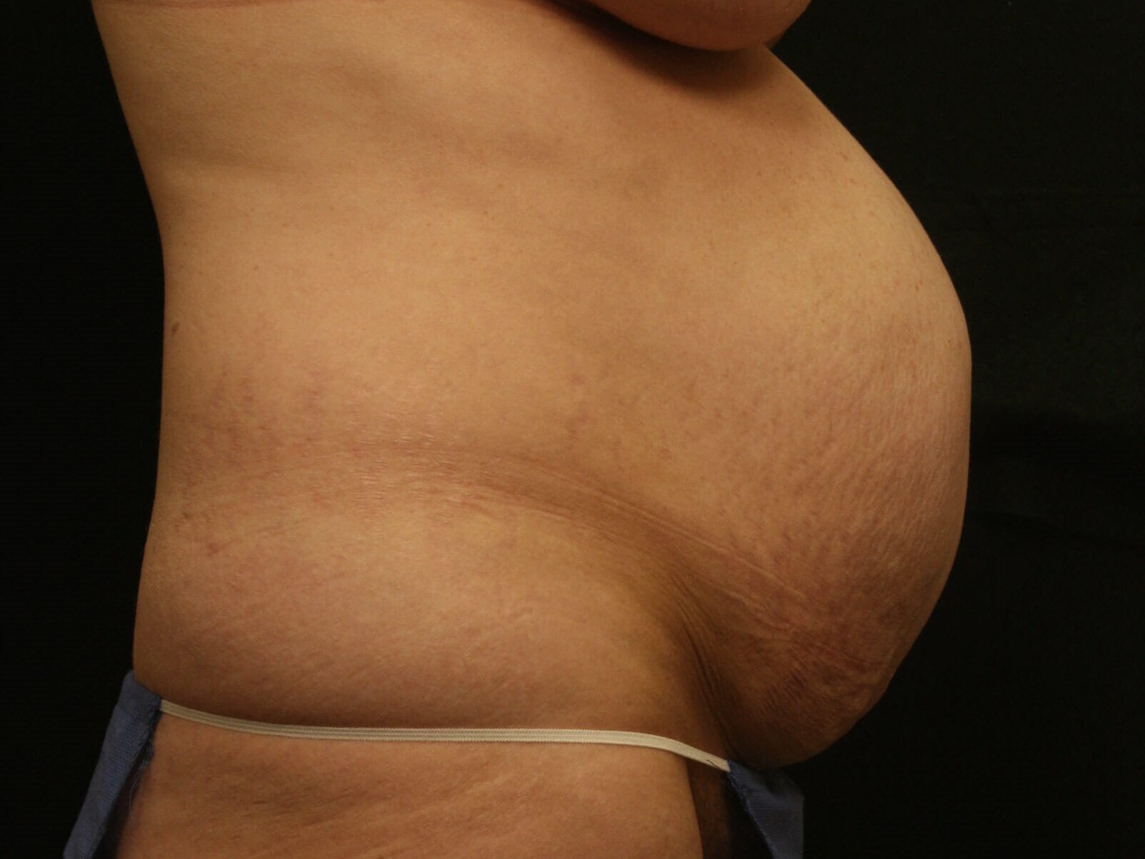 Tummy Tuck Before and After Before