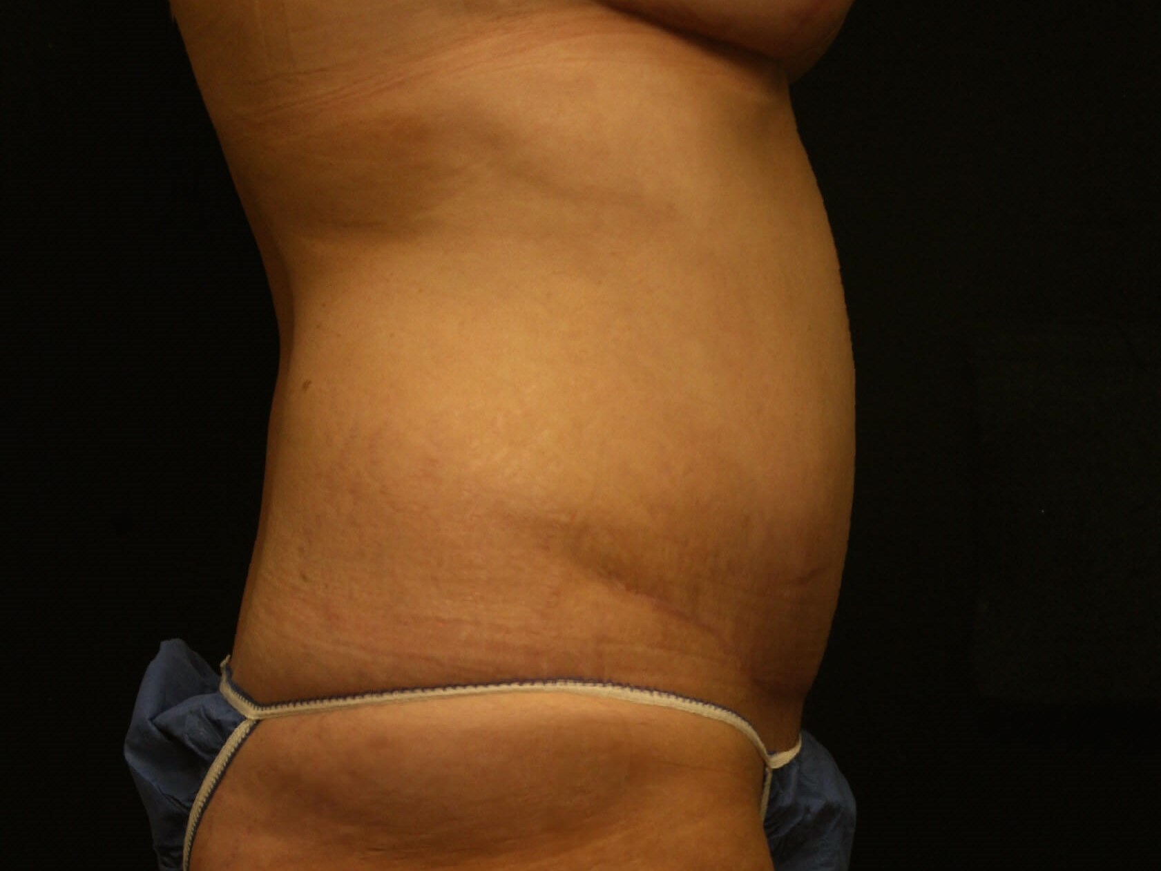 Tummy Tuck Before and After After