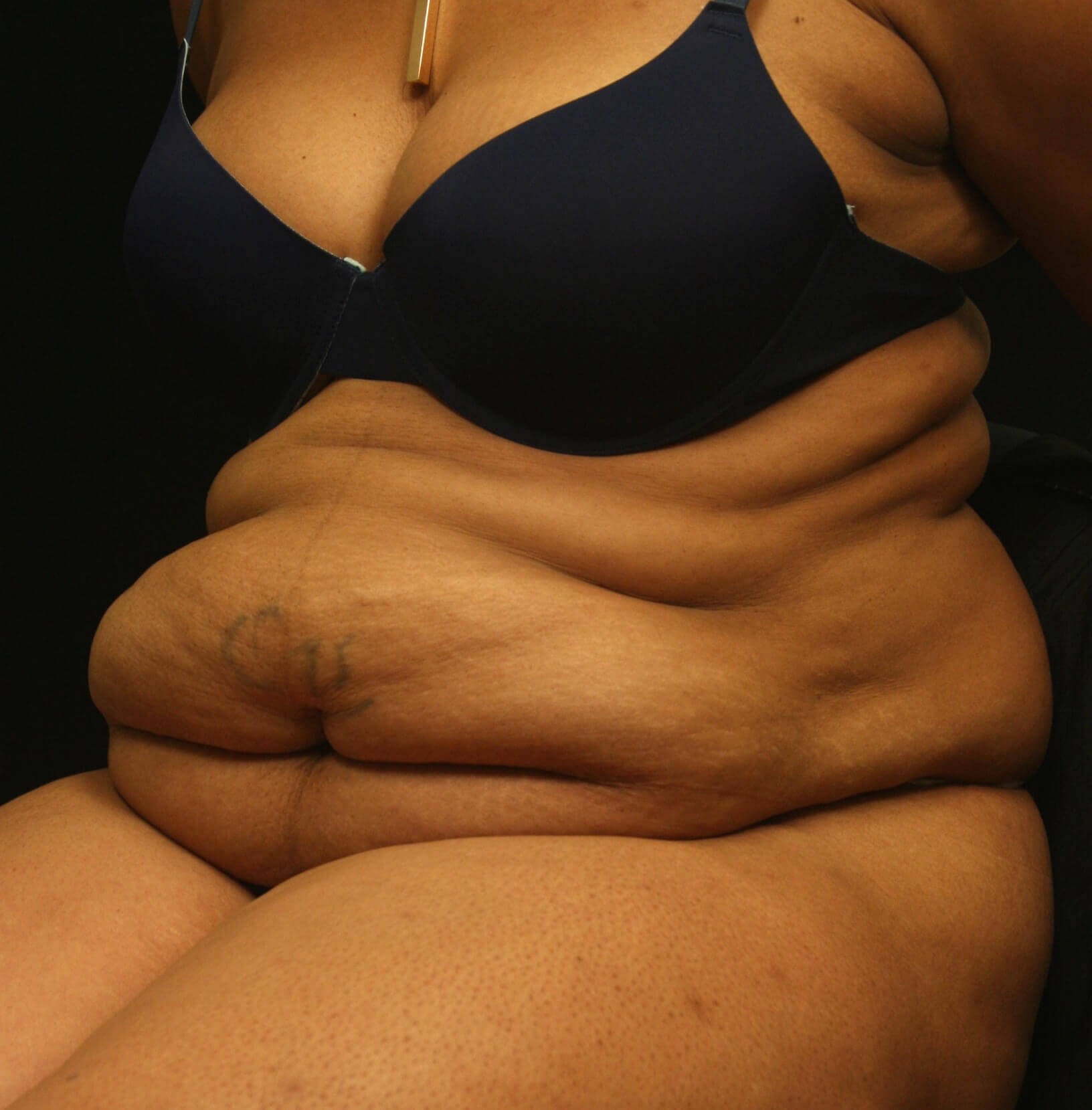 Abdominoplasty Results Before