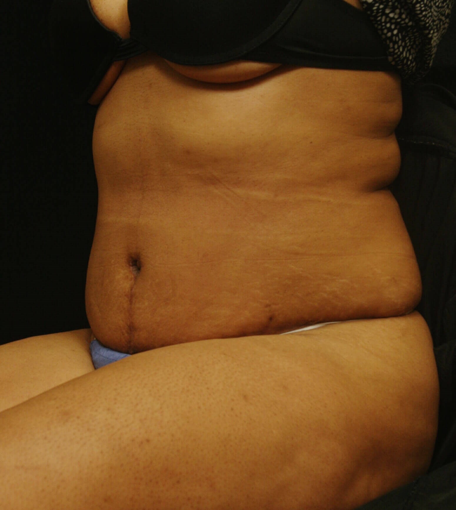 Abdominoplasty Results After