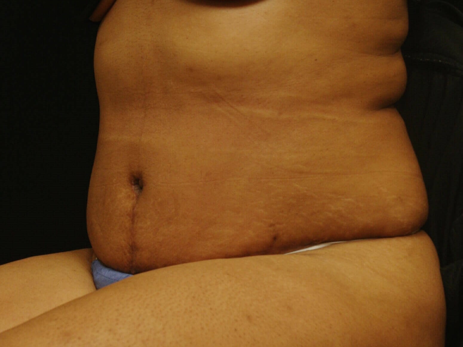 Abdominoplasty Results After