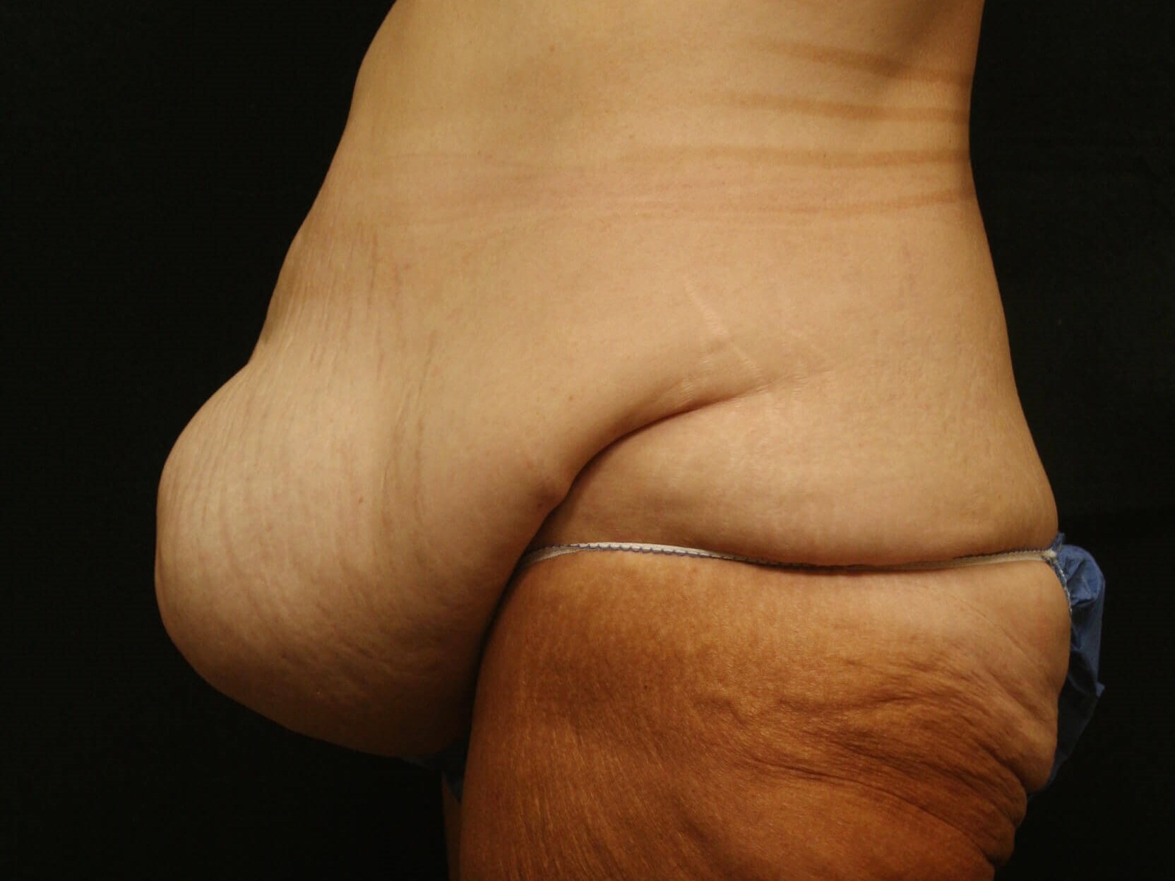 Abdominoplasty Results Before
