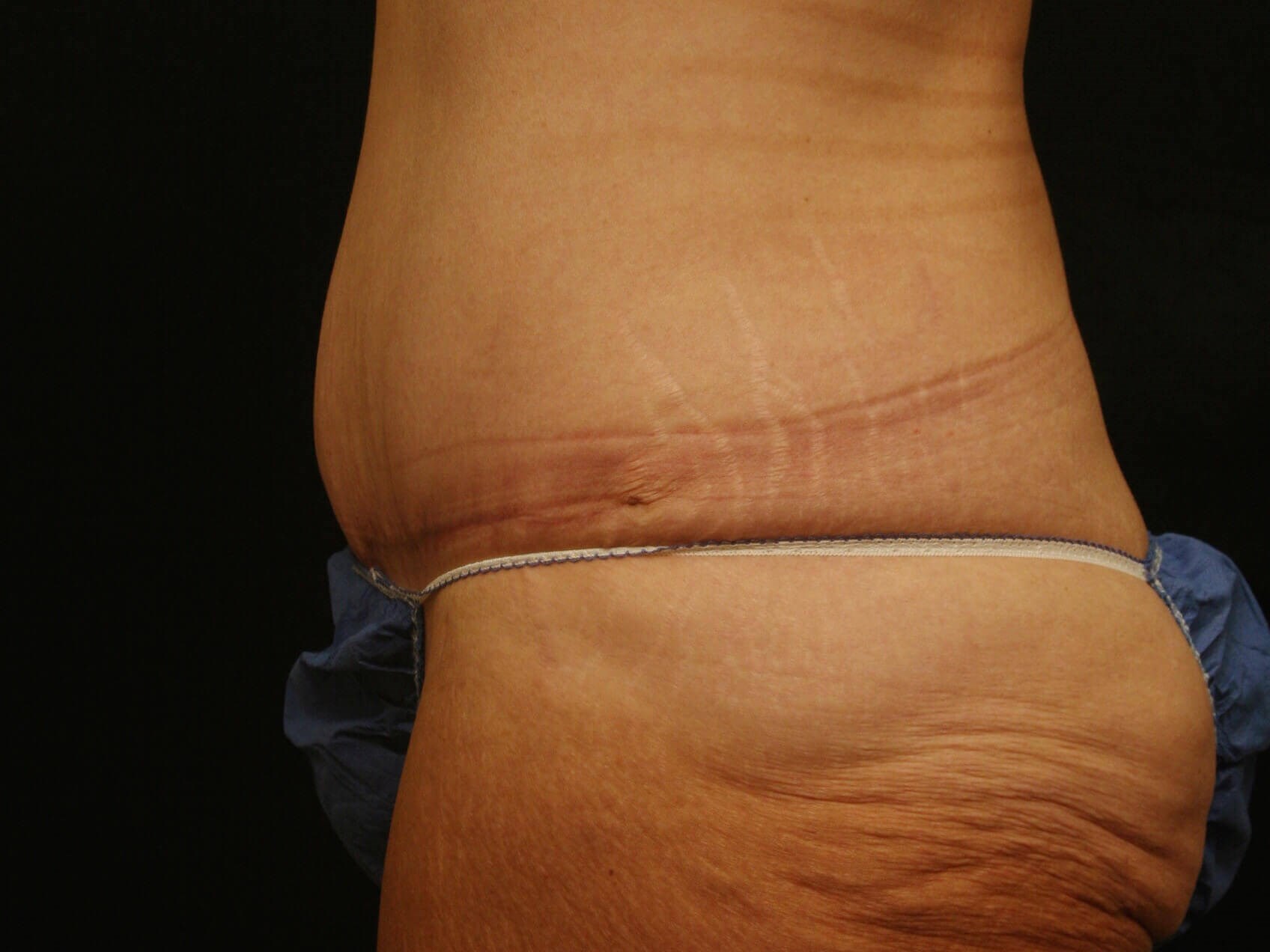 Abdominoplasty Results After