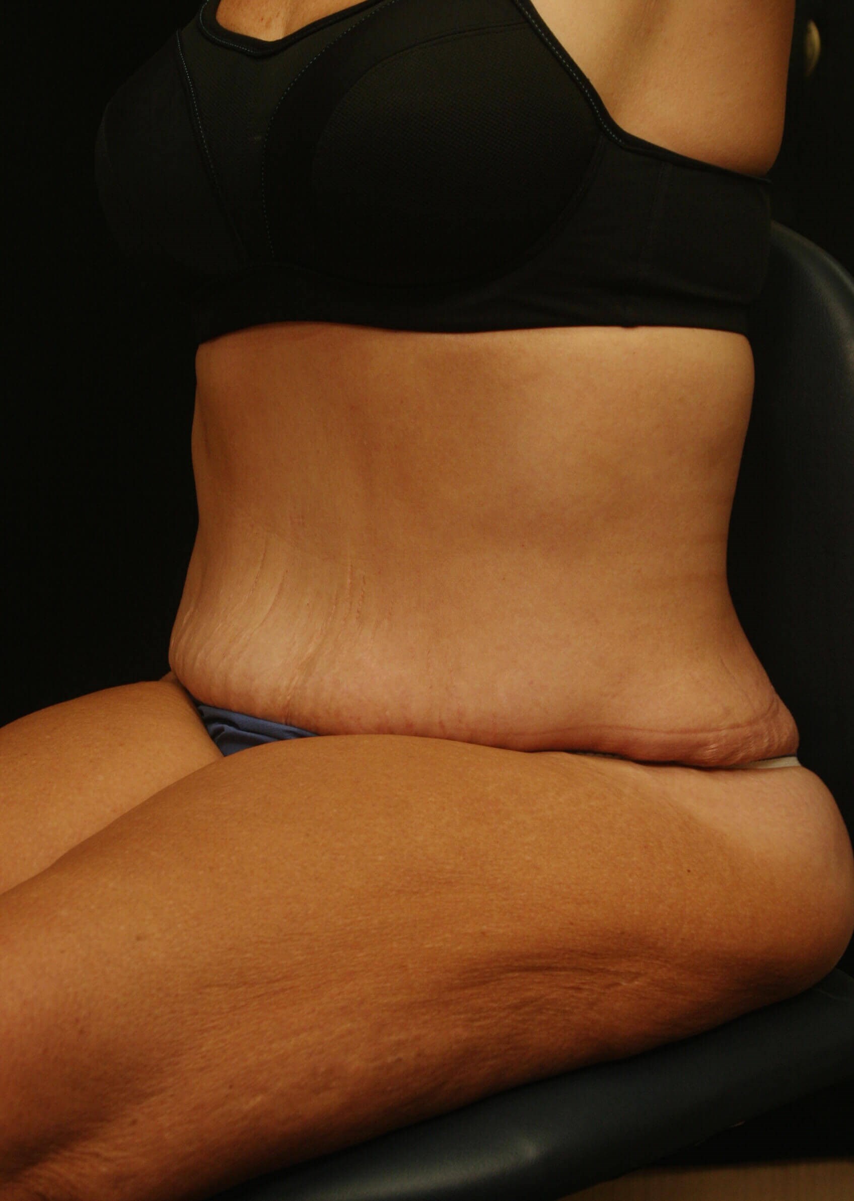 Abdominoplasty Results After