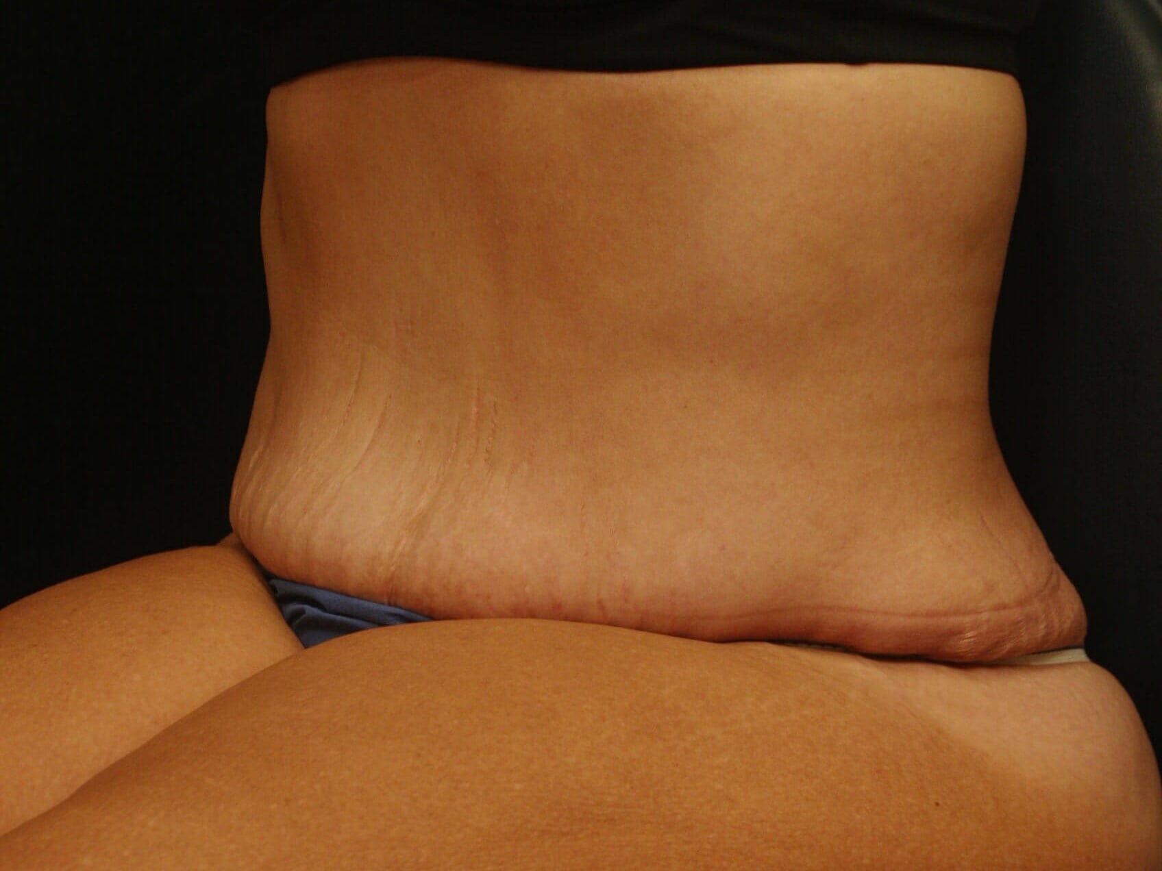 Abdominoplasty Results After