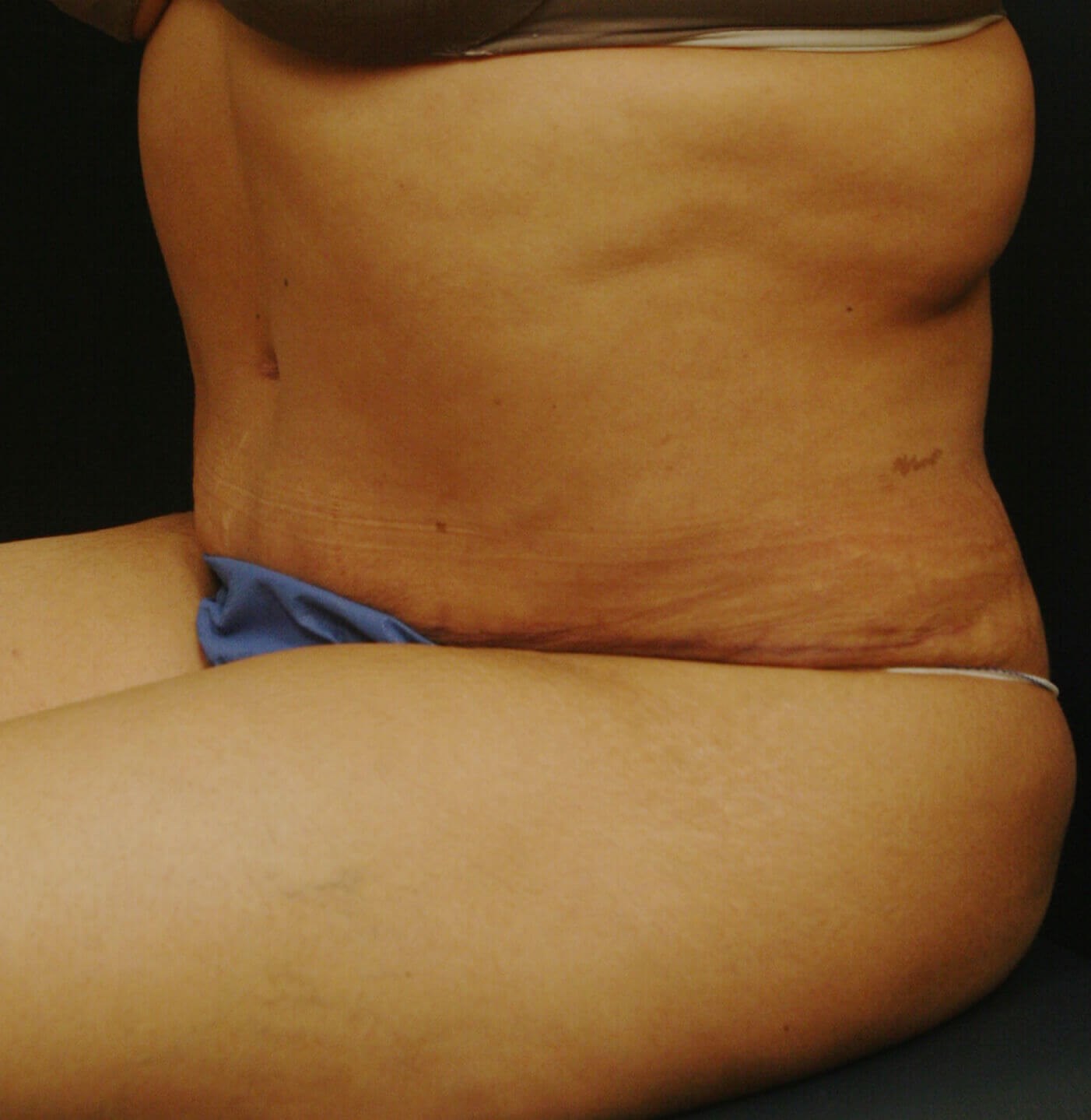 Abdominoplasty Results After