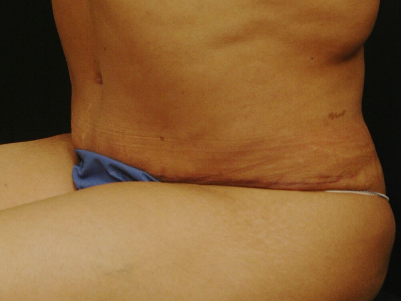 Abdominoplasty Results After