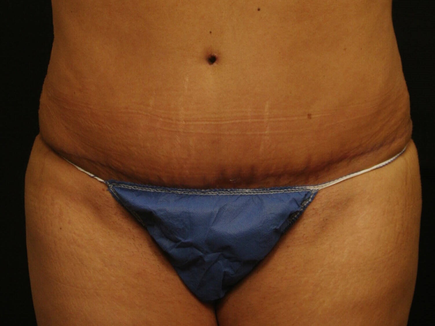 Abdominoplasty Results After