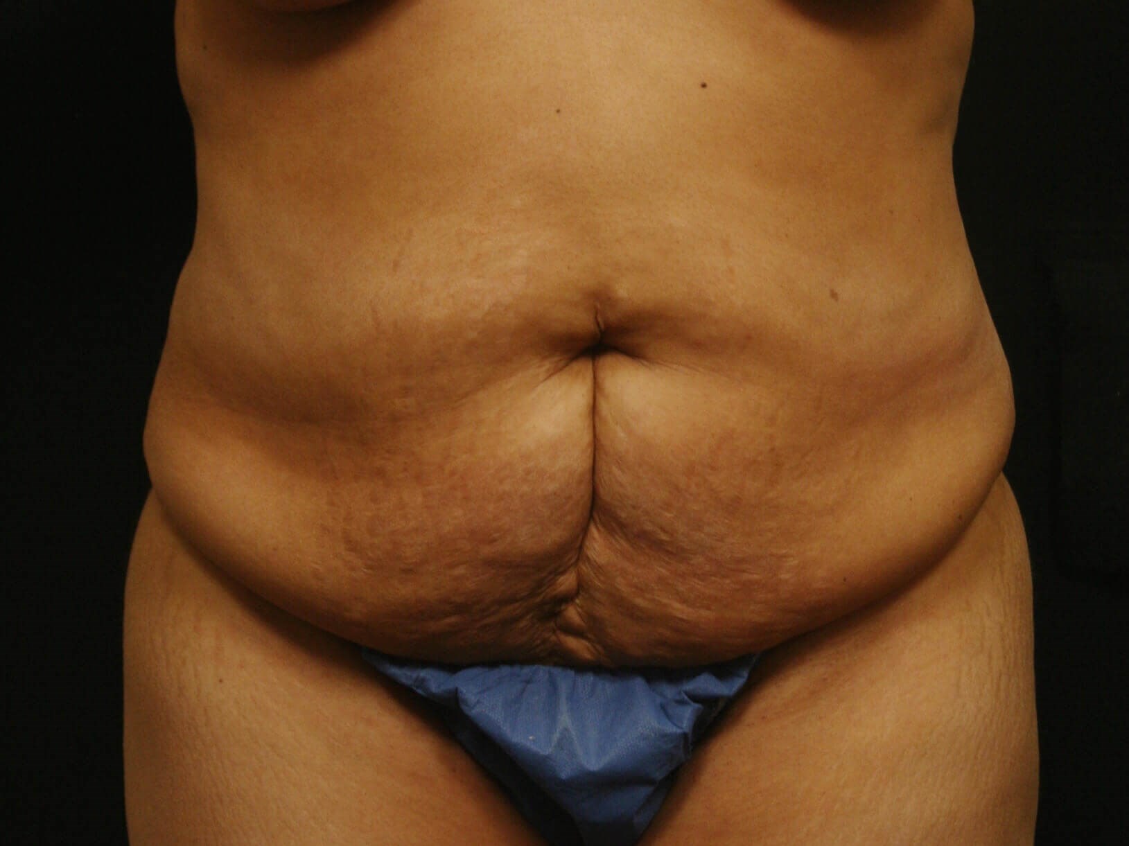 Abdominoplasty Results Before