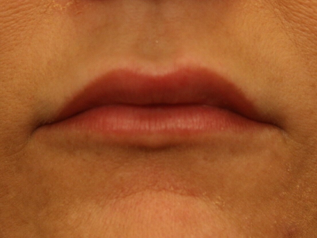 Lip Augmentation Results After