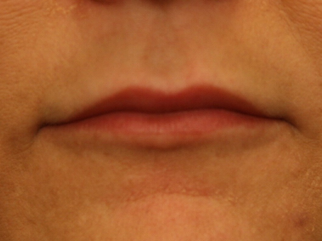 Lip Augmentation Results Before
