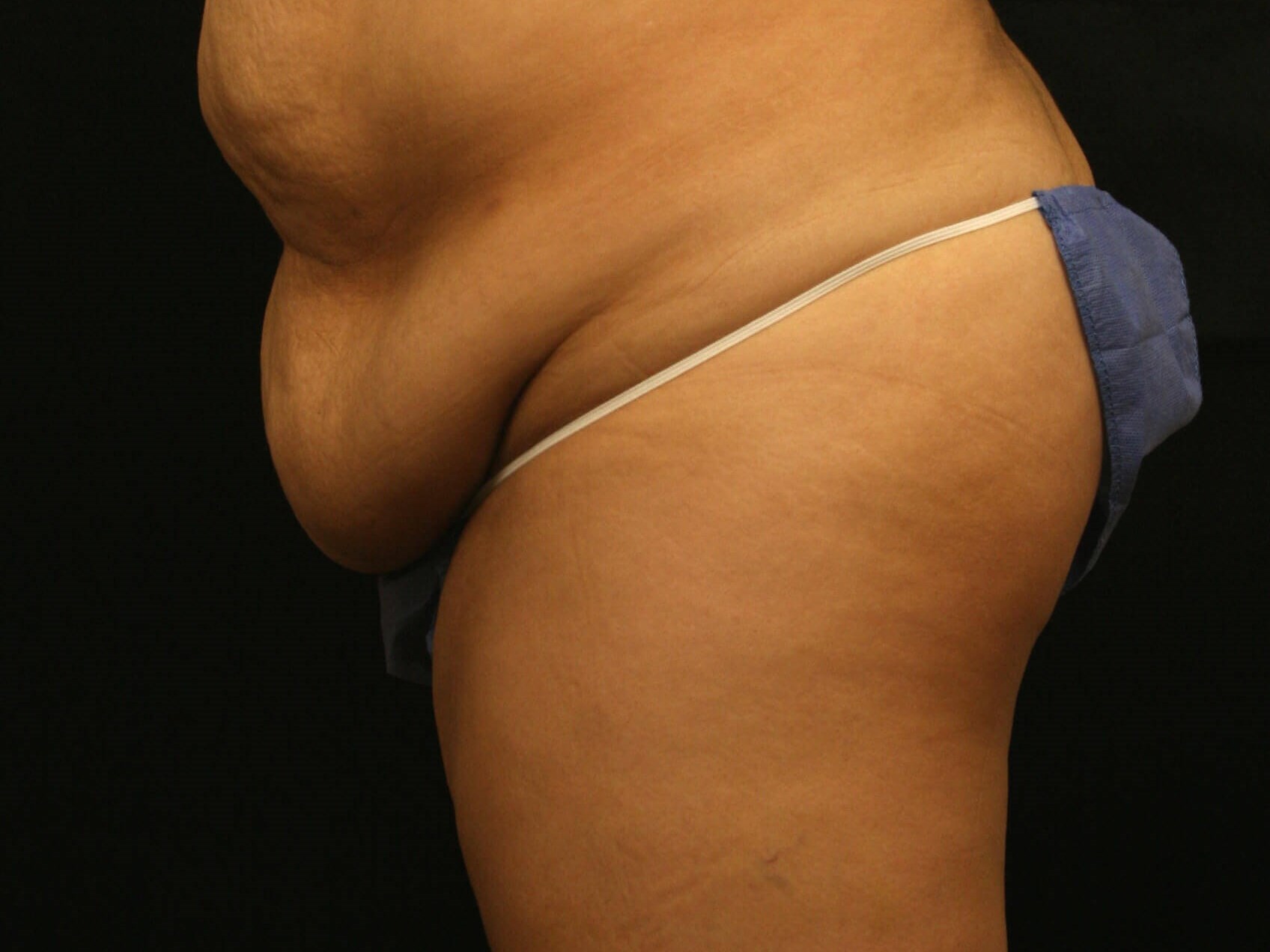 Abdominoplasty Results Before