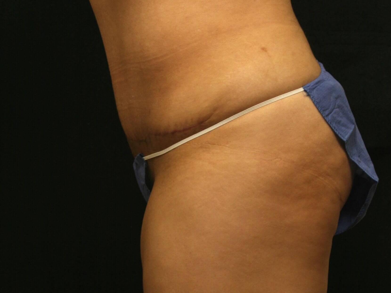 Abdominoplasty Results After