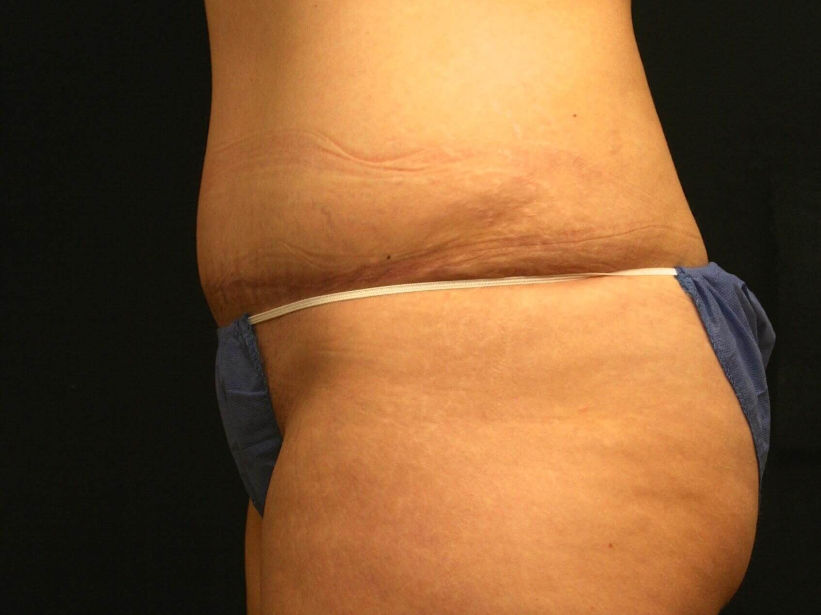 Abdominoplasty Results After