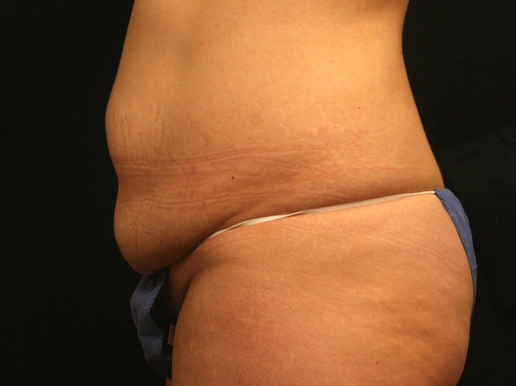 Abdominoplasty Results Before