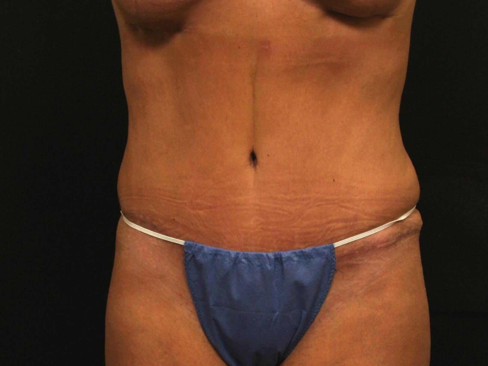 Mommy Makeover Results After