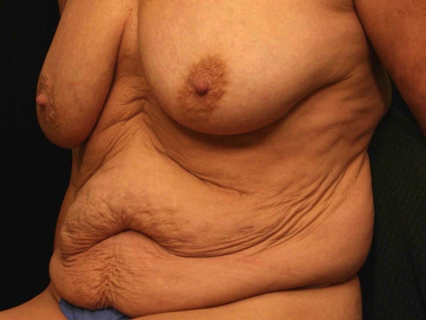 Mommy Makeover Results Before