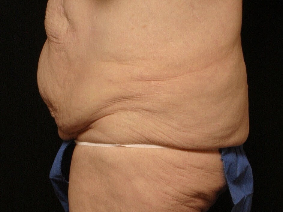 Body Lift Before and After Before