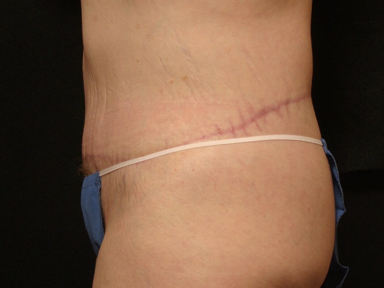 Body Lift Before and After After